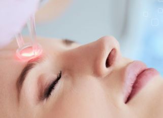 So sánh Laser CO2  thuỷ tinh và kim loại RF